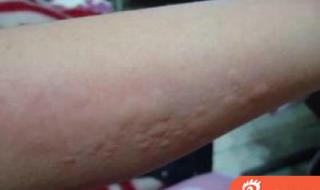 治疗慢性荨麻疹的药 治疗慢性荨麻疹的药