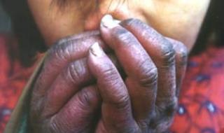 艾滋病最初皮疹图片